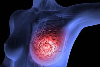 Breast cancer Breast cancer
