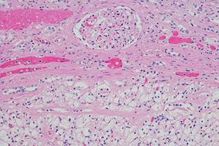 Researchers evaluated the outcomes of 222 patients with clear cell RCC and assessed the impact of rVFA on survival. Researchers evaluated the outcomes of 222 patients with clear cell RCC and assessed the impact of rVFA on survival.