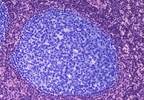 Benefit of Lymph Node Biopsies May Be Limited in Microinvasive Breast Cancer Benefit of Lymph Node Biopsies May Be Limited in Microinvasive Breast Cancer