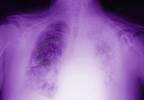 Evolving Role of Radiation Therapy in the Treatment of Mesothelioma Evolving Role of Radiation Therapy in the Treatment of Mesothelioma