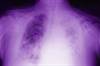 Evolving Role of Radiation Therapy in the Treatment of Mesothelioma Evolving Role of Radiation Therapy in the Treatment of Mesothelioma