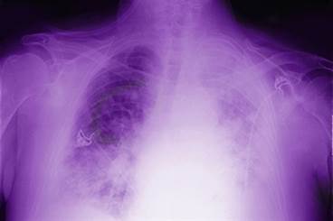 Evolving Role of Radiation Therapy in the Treatment of Mesothelioma Evolving Role of Radiation Therapy in the Treatment of Mesothelioma
