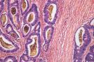 Insurance Type Influences Colon Cancer Survival Insurance Type Influences Colon Cancer Survival