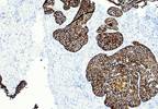 Incidence, Age at Diagnosis Increasing in HPV-Positive Oropharyngeal Squamous Cell Carcinoma Incidence, Age at Diagnosis Increasing in HPV-Positive Oropharyngeal Squamous Cell Carcinoma