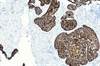 Revised AJCC8 Demonstrates Superior Tumor Classification for HNCSCC Revised AJCC8 Demonstrates Superior Tumor Classification for HNCSCC