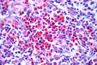 Analysis revealed that incidence rates for aHL was the highest between 1984 and 1993. Analysis revealed that incidence rates for aHL was the highest between 1984 and 1993.