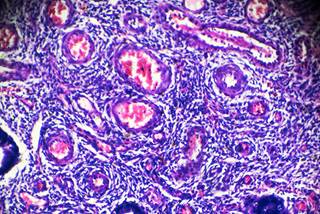 CCRT is an adjuvant therapy for women with early-stage cervical cancer following radical hysterectomy, despite side effects. CCRT is an adjuvant therapy for women with early-stage cervical cancer following radical hysterectomy, despite side effects.