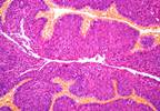 5-ARI Use Before, After Diagnosis Significantly Reduced Bladder Cancer-Specific Death 5-ARI Use Before, After Diagnosis Significantly Reduced Bladder Cancer-Specific Death