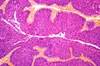 5-ARI Use Before, After Diagnosis Significantly Reduced Bladder Cancer-Specific Death 5-ARI Use Before, After Diagnosis Significantly Reduced Bladder Cancer-Specific Death