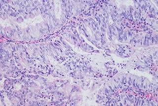 Bevacizumab, ixabepilone, and temsirolimus have demonstrated potential activity in endometrial cancer in previous studies. Bevacizumab, ixabepilone, and temsirolimus have demonstrated potential activity in endometrial cancer in previous studies.