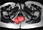 Guideline Recommendations Offer No OS Benefit for Younger Patients With Rectal Cancer Guideline Recommendations Offer No OS Benefit for Younger Patients With Rectal Cancer