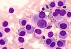 Is Radioimmunotherapy a Path Forward for Melanoma? Is Radioimmunotherapy a Path Forward for Melanoma?
