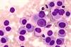 Is Radioimmunotherapy a Path Forward for Melanoma? Is Radioimmunotherapy a Path Forward for Melanoma?