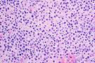 FDA, EU Approvals Sought for Split Dose Regimen of Daratumumab for Multiple Myeloma FDA, EU Approvals Sought for Split Dose Regimen of Daratumumab for Multiple Myeloma