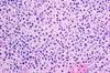 FDA, EU Approvals Sought for Split Dose Regimen of Daratumumab for Multiple Myeloma FDA, EU Approvals Sought for Split Dose Regimen of Daratumumab for Multiple Myeloma