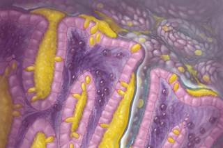 Chemotherapy conditioning with busulfan is a critical component prior to HCT, but mucositis is a possibility. Chemotherapy conditioning with busulfan is a critical component prior to HCT, but mucositis is a possibility.