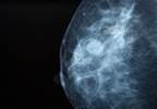 Should Increased Breast Density Dictate More Breast Cancer Screenings? Should Increased Breast Density Dictate More Breast Cancer Screenings?