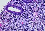 RiBVD Effective in the First-Line Setting for Mantle Cell Lymphoma RiBVD Effective in the First-Line Setting for Mantle Cell Lymphoma