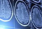 CNS Tumors in Childhood: Predicting Successful Independence in Adult Life CNS Tumors in Childhood: Predicting Successful Independence in Adult Life