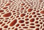 Case Study: Myelofibrosis Diagnosis and Early Intervention Case Study: Myelofibrosis Diagnosis and Early Intervention