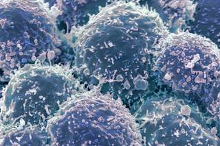 Lung cancer cells, coloured scanning electron micrograph (SEM). Lung cancer cells, coloured scanning electron micrograph (SEM).