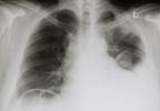 Nedaplatin Associated With Less Toxicity Than Cisplatin for MPE Nedaplatin Associated With Less Toxicity Than Cisplatin for MPE