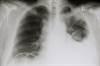 Nedaplatin Associated With Less Toxicity Than Cisplatin for MPE Nedaplatin Associated With Less Toxicity Than Cisplatin for MPE