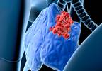 Postoperative Radiotherapy Favorable as Adjuvant Treatment for Thymic Neuroendocrine Tumors Postoperative Radiotherapy Favorable as Adjuvant Treatment for Thymic Neuroendocrine Tumors