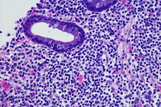 A subset of marginal zone lymphomas transform into higher-grade lymphomas. A subset of marginal zone lymphomas transform into higher-grade lymphomas.