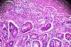 Neoadjuvant FOLFIRINOX a Better Option Than Surgery Plus Adjuvant Therapy in Pancreatic Cancer Neoadjuvant FOLFIRINOX a Better Option Than Surgery Plus Adjuvant Therapy in Pancreatic Cancer
