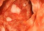 Potential of Fecal Microbiota Transplantation in Managing Immunotherapy-Associated Colitis Potential of Fecal Microbiota Transplantation in Managing Immunotherapy-Associated Colitis