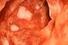 Potential of Fecal Microbiota Transplantation in Managing Immunotherapy-Associated Colitis Potential of Fecal Microbiota Transplantation in Managing Immunotherapy-Associated Colitis