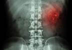 Kidney Stones Tied to Increased Renal Cell Carcinoma Risk Kidney Stones Tied to Increased Renal Cell Carcinoma Risk