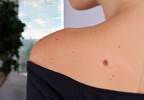 Number of Cutaneous Nevi Associated With Mortality Risk in Melanoma, Particularly for Men Number of Cutaneous Nevi Associated With Mortality Risk in Melanoma, Particularly for Men