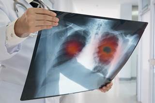 Previous studies have shown an association between administration of systemic chemotherapy in advanced thoracic cancers and HRQoL deficits. Previous studies have shown an association between administration of systemic chemotherapy in advanced thoracic cancers and HRQoL deficits.