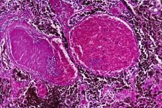 Current evidence for the safety and efficacy of sequential administration of immunotherapy and targeted therapy in patients with advanced melanoma in scarce. Current evidence for the safety and efficacy of sequential administration of immunotherapy and targeted therapy in patients with advanced melanoma in scarce.