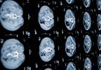 USPSTF Still Recommends Against Pancreatic Cancer Screening USPSTF Still Recommends Against Pancreatic Cancer Screening