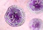 A Review of Clinical Outcomes in Patients With Early-Stage Burkitt Lymphoma A Review of Clinical Outcomes in Patients With Early-Stage Burkitt Lymphoma