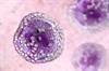 A Review of Clinical Outcomes in Patients With Early-Stage Burkitt Lymphoma A Review of Clinical Outcomes in Patients With Early-Stage Burkitt Lymphoma