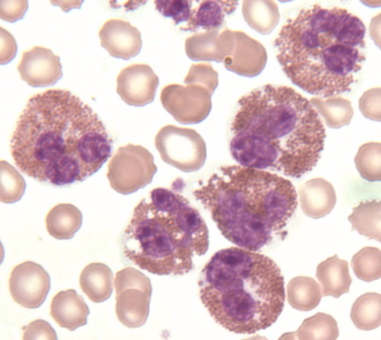 Leukocytosis - ONA