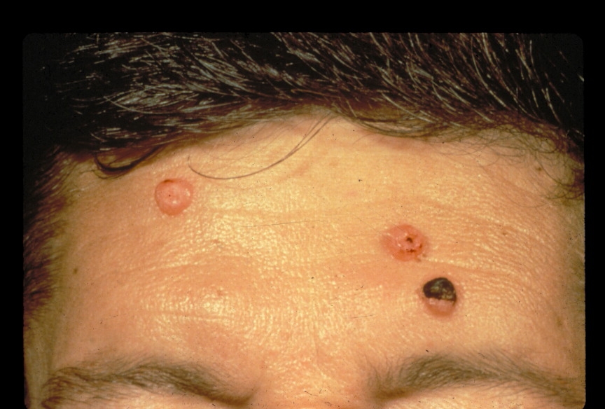 Disseminated fungal infection ONA