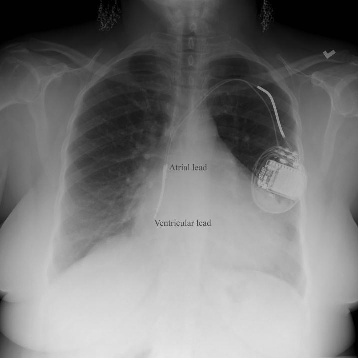 Cardiac Implantable Electrical Devices: Management of Complications ...